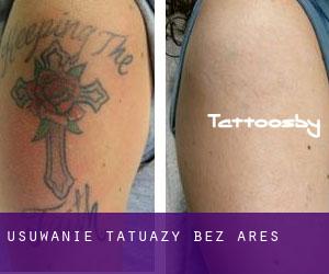 Usuwanie tatuaży bez ares