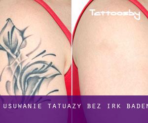 Usuwanie tatuaży bez irk Baden