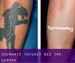 Usuwanie tatuaży bez irk Gersau