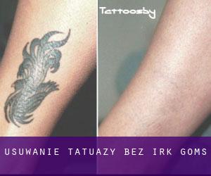 Usuwanie tatuaży bez irk Goms