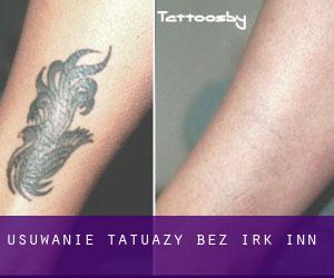 Usuwanie tatuaży bez irk Inn
