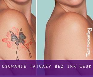 Usuwanie tatuaży bez irk Leuk