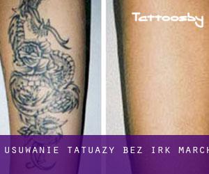 Usuwanie tatuaży bez irk March
