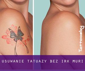 Usuwanie tatuaży bez irk Muri