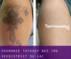Usuwanie tatuaży bez irk See/District du Lac
