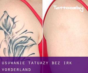 Usuwanie tatuaży bez irk Vorderland