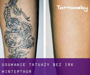 Usuwanie tatuaży bez irk Winterthur
