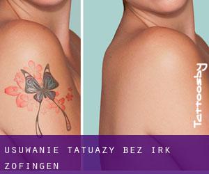 Usuwanie tatuaży bez irk Zofingen