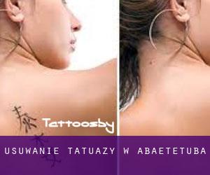 Usuwanie tatuaży w Abaetetuba