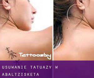 Usuwanie tatuaży w Abaltzisketa