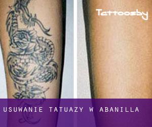 Usuwanie tatuaży w Abanilla