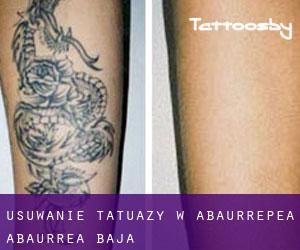 Usuwanie tatuaży w Abaurrepea / Abaurrea Baja