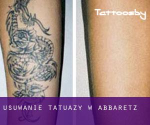 Usuwanie tatuaży w Abbaretz