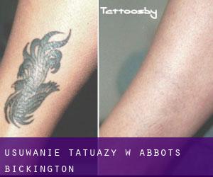 Usuwanie tatuaży w Abbots Bickington