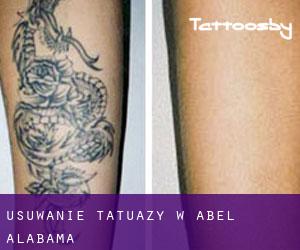 Usuwanie tatuaży w Abel (Alabama)