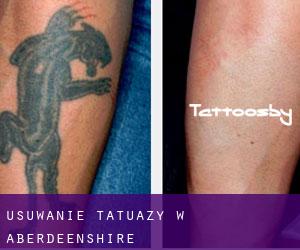 Usuwanie tatuaży w Aberdeenshire