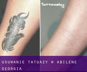 Usuwanie tatuaży w Abilene (Georgia)