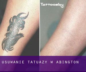 Usuwanie tatuaży w Abington