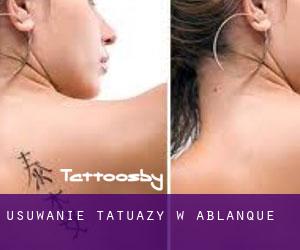 Usuwanie tatuaży w Ablanque