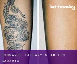Usuwanie tatuaży w Ablers (Bawaria)