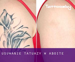 Usuwanie tatuaży w Aboite