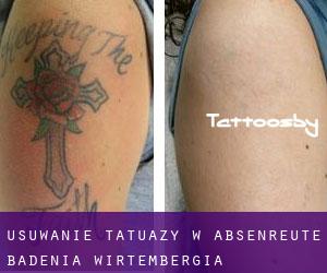 Usuwanie tatuaży w Absenreute (Badenia-Wirtembergia)