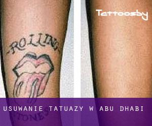 Usuwanie tatuaży w Abu Dhabi