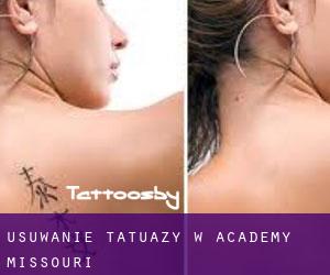 Usuwanie tatuaży w Academy (Missouri)