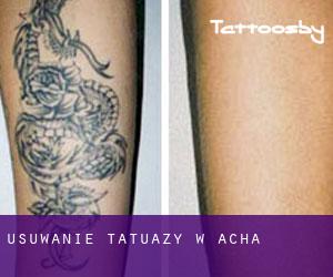 Usuwanie tatuaży w Acha