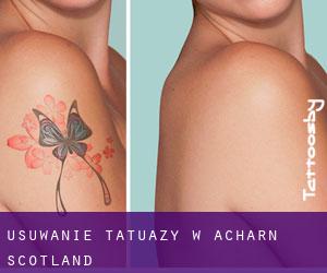 Usuwanie tatuaży w Acharn (Scotland)