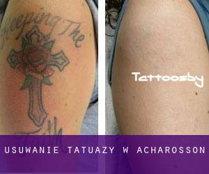 Usuwanie tatuaży w Acharosson