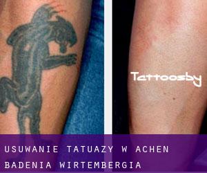 Usuwanie tatuaży w Achen (Badenia-Wirtembergia)