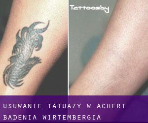 Usuwanie tatuaży w Achert (Badenia-Wirtembergia)
