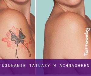 Usuwanie tatuaży w Achnasheen