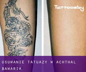 Usuwanie tatuaży w Achthal (Bawaria)