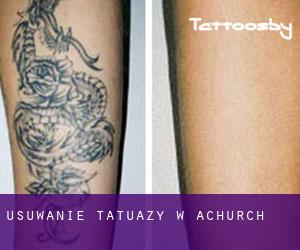 Usuwanie tatuaży w Achurch
