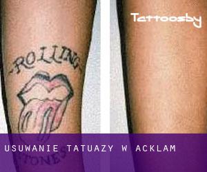 Usuwanie tatuaży w Acklam