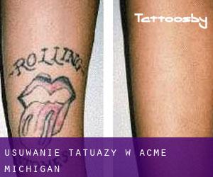 Usuwanie tatuaży w Acme (Michigan)