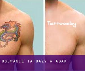Usuwanie tatuaży w Adak