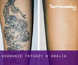 Usuwanie tatuaży w Adalia