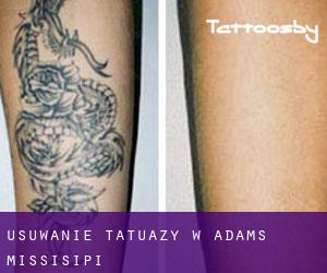 Usuwanie tatuaży w Adams (Missisipi)