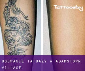 Usuwanie tatuaży w Adamstown Village