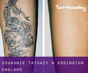 Usuwanie tatuaży w Addington (England)