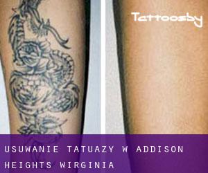 Usuwanie tatuaży w Addison Heights (Wirginia)