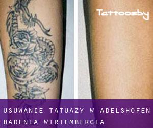 Usuwanie tatuaży w Adelshofen (Badenia-Wirtembergia)