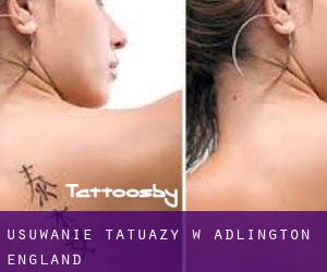 Usuwanie tatuaży w Adlington (England)