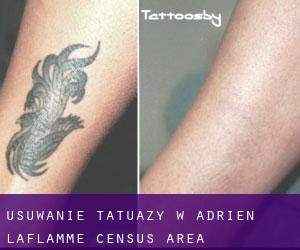 Usuwanie tatuaży w Adrien-Laflamme (census area)