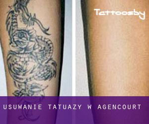 Usuwanie tatuaży w Agencourt