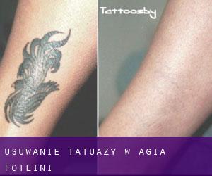 Usuwanie tatuaży w Agía Foteiní