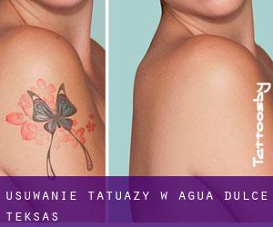 Usuwanie tatuaży w Agua Dulce (Teksas)